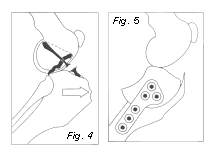 Tibial Plateau Leveling Osteotomy Figure 4, 5
